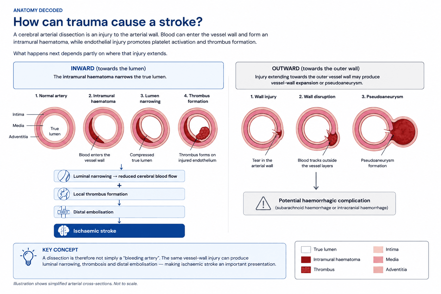Diagram showing how arterial dissection following trauma can cause intramural haematoma, luminal narrowing, thrombus formation, distal embolisation and ischaemic stroke, or outward vessel-wall disruption and pseudoaneurysm.