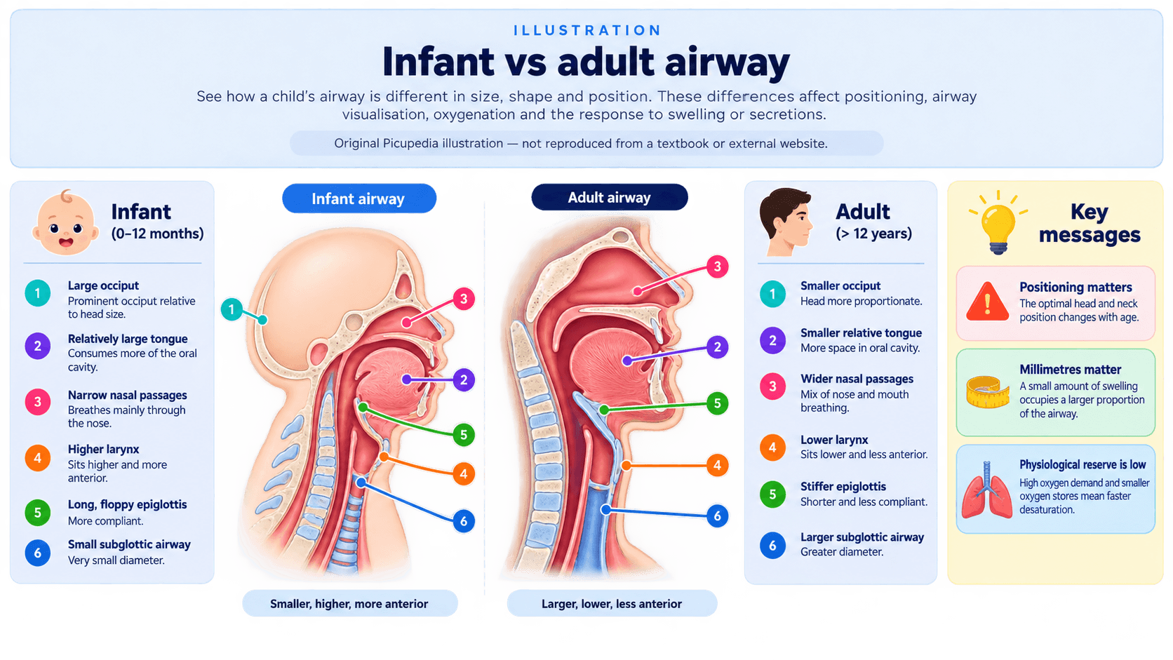 Illustration comparing infant and adult upper airway anatomy